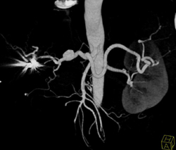 Hepatic Artery Aneurysm - CTisus CT Scan