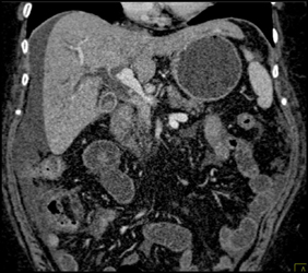 Tumor Infiltration of the Distal Common Bile Duct (CBD) - CTisus CT Scan