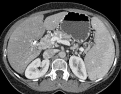 Cavernous Transformation of the Portal Vein With Portal Hypertension - CTisus CT Scan