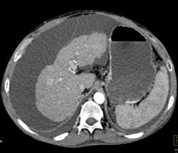 Cirrhosis - CTisus CT Scan