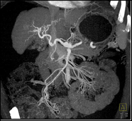 Cirrhosis - CTisus CT Scan