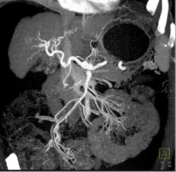 Cirrhosis - CTisus CT Scan