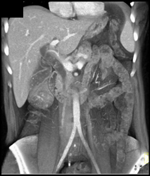 Stones in Distal Common Bile Duct (CBD) Causing Obstruction - CTisus CT Scan