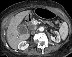 Dilated Common Bile Duct (CBD) Due to Ampullary Mass - CTisus CT Scan