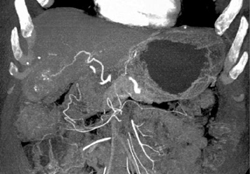 Hepatoma - CTisus CT Scan