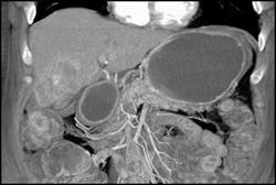 Hepatoma - CTisus CT Scan