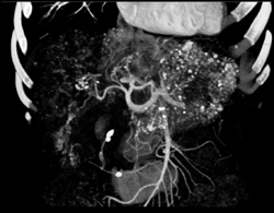 Hepatoma With Chemoembolization - CTisus CT Scan