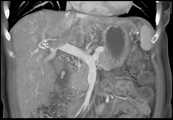 Hepatoma With Clot in Portal Vein - CTisus CT Scan