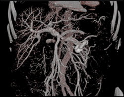 3D Mapping of Portal Venous System - CTisus CT Scan