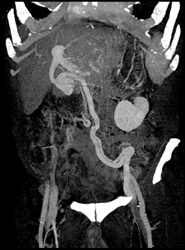 Large Varices - CTisus CT Scan