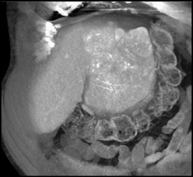 Hepatoma With Neovascularity - CTisus CT Scan