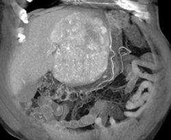 Hepatoma With Neovascularity - CTisus CT Scan