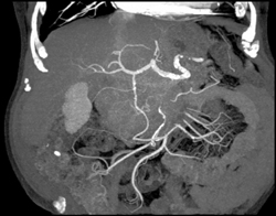 Hepatoma With Neovascularity - CTisus CT Scan