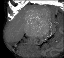 Hepatoma With Neovascularity - CTisus CT Scan