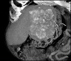 Hepatoma With Neovascularity - CTisus CT Scan