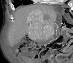 Hepatoma With Neovascularity - CTisus CT Scan