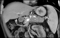 Chronic Pancreatitis - CTisus CT Scan