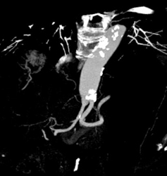 Hepatic and Splenic Artery Arise Directly Off Aorta - CTisus CT Scan