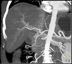 VRT Vs MIP of Hepatic Artery - CTisus CT Scan