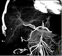 Normal Branching Off Hepatic Artery - CTisus CT Scan