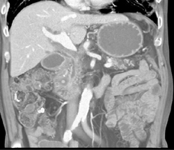 Encasement of the Portal Vein and Common Bile Duct (CBD) Due to Infiltration By Tumor - CTisus CT Scan