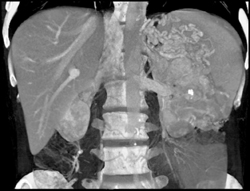 Islet Cell Tumor Invades the PV/SMV - CTisus CT Scan