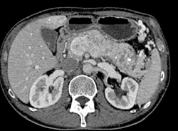 Islet Cell Tumor Infiltrates the Pancreas With Liver Metastases - CTisus CT Scan