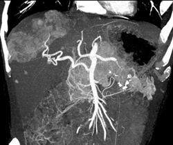 Impressive Vascular Liver Metastases From Islet Cell of the Pancreas - CTisus CT Scan