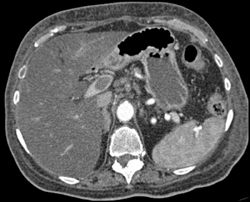 Pancreatic Cancer Encases the Celiac Artery and Invades the Portal Vein - CTisus CT Scan