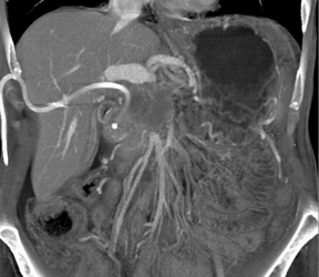 Pancreatic Cancer Occludes the Portal Vein - CTisus CT Scan