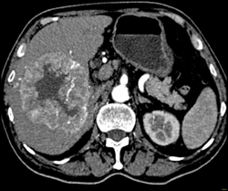 Hepatoma With Neovascularity - CTisus CT Scan