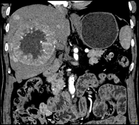 Hepatoma With Neovascularity - CTisus CT Scan