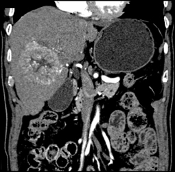 Hepatoma With Neovascularity - CTisus CT Scan