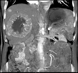 Hepatoma With Neovascularity - CTisus CT Scan