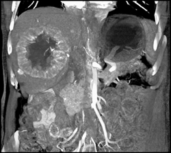 Hepatoma With Neovascularity - CTisus CT Scan