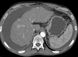 Regenerating Nodules - CTisus CT Scan