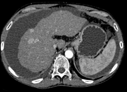 Regenerating Nodules - CTisus CT Scan