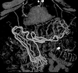 Extensive Varices and Collaterals - CTisus CT Scan