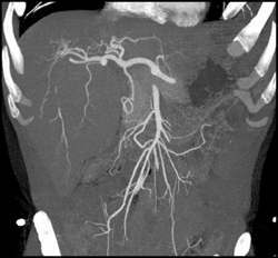 Splaying of Hepatic Artery By Mass in Right Lobe of Liver - CTisus CT Scan