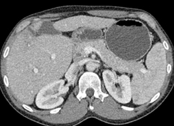 Hepatic Artery Aneurysm - CTisus CT Scan