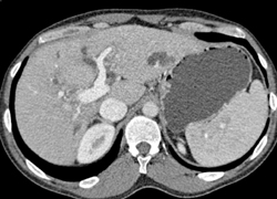 Subtle Hepatic Laceration - CTisus CT Scan