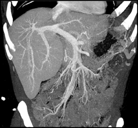 Right Portal Vein Is Splayed By the Tumor - CTisus CT Scan