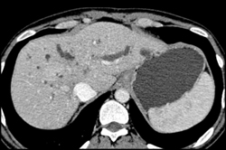 Dilated Left Ductal System - CTisus CT Scan