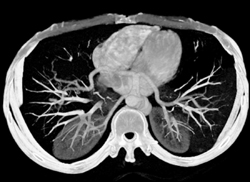 Base of Heart Creates A Pseudo Lesion in the Left Lobe of the Liver - CTisus CT Scan