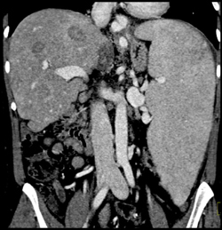 Liver Abscesses in A Cirrhotic Patient - CTisus CT Scan