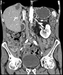 Abscesses S/P Whipple Procedure - CTisus CT Scan