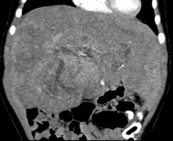 Infiltrating Tumor - CTisus CT Scan