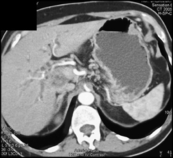 Tumor Infiltrates the Portal Vein - CTisus CT Scan