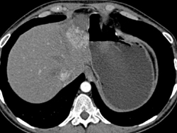 Focal Nodular Hyperplasia (FNH) in Left Lobe of the Liver - CTisus CT Scan