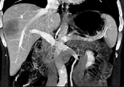 Hepatoma - CTisus CT Scan